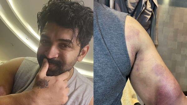 Achcham Enbadhu Illayae: Arun Vijay injured again, shares pictures of his bruises