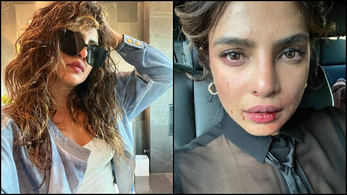 Priyanka Chopra bruised on the sets of Citadel, asks, 'Did you have a ...