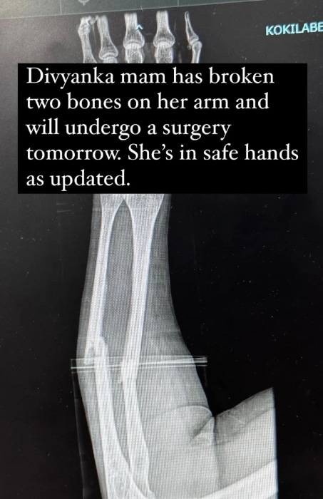 Divyanka accident X-ray